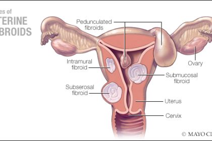 Empowering Change: NIH Funds Groundbreaking Center at Mayo Clinic to Tackle Health Disparities in Uterine Fibroid Treatment