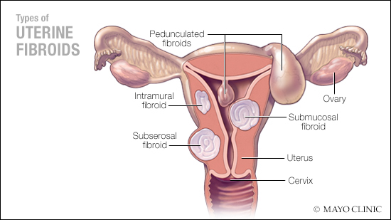 Empowering Change: NIH Funds Groundbreaking Center at Mayo Clinic to Tackle Health Disparities in Uterine Fibroid Treatment