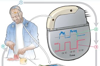 Revolutionary Self-Adjusting Brain Pacemaker Holds Promise for Easing Parkinson’s Disease Symptoms!