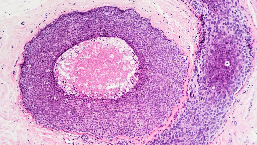 Understanding ‘Stage 0’ Breast Cancer: What You Need to Know About This Early-Stage Diagnosis and Its Treatment Options!