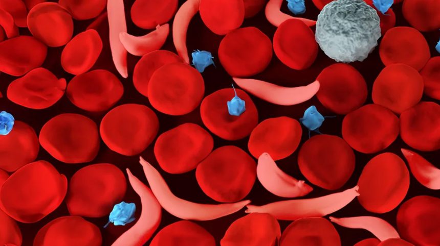 Hidden Dangers: How Sickle Cell Disease Carriers Face Elevated Blood Clot Risks Across All Ancestries!