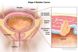 Unlocking Hope: How Immunotherapy After Surgery is Transforming Lives for High-Risk Bladder Cancer Patients