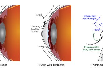 Revolutionary Findings: Two Surgeries Offer Equal Hope in Treating Blinding Eyelid Condition!