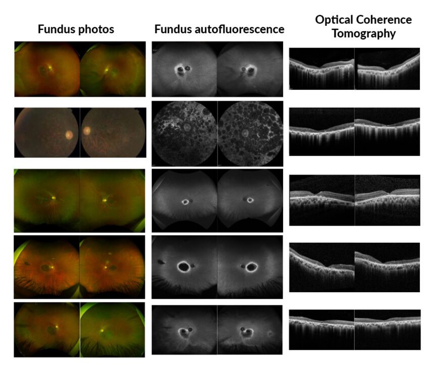 Breakthrough Discovery: Scientists Uncover Gene Behind Rare Inherited Eye Disease!